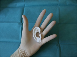 Firenze, ricostruito orecchio a un bambino grazie alla stampa 3D